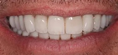 MYO Dental all-on-4 after
