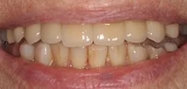 MYO Dental all on 4 after