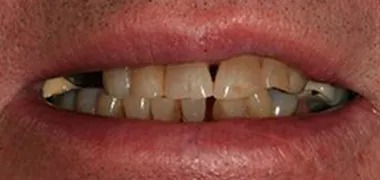 MYO Dental all-on-4 before