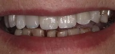 MYO Dental dental implant after