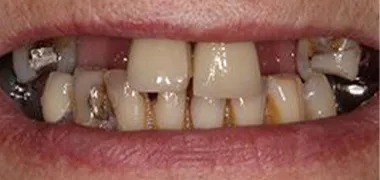 MYO Dental dental implant before