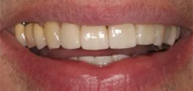 MYO Dental new denture after