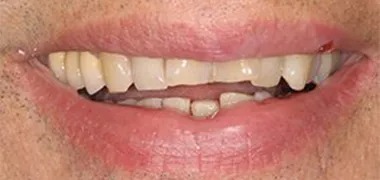 MYO Dental new denture before