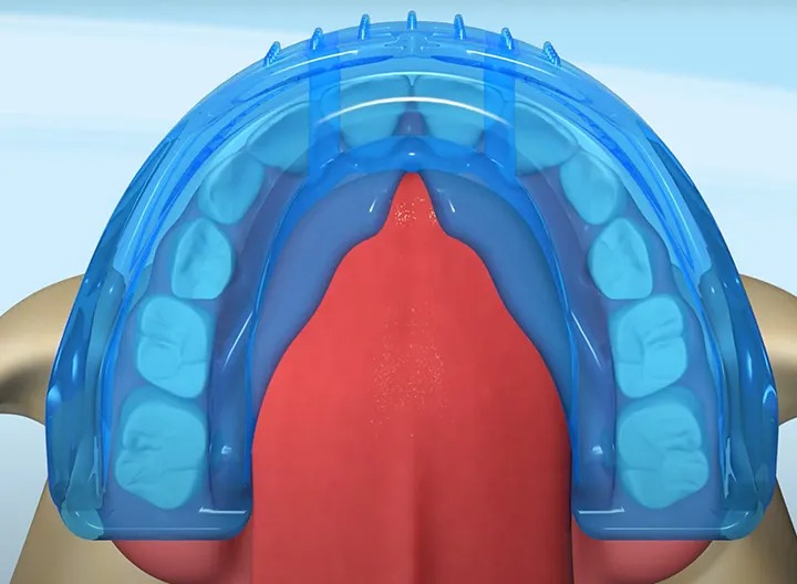 picture of myobrace