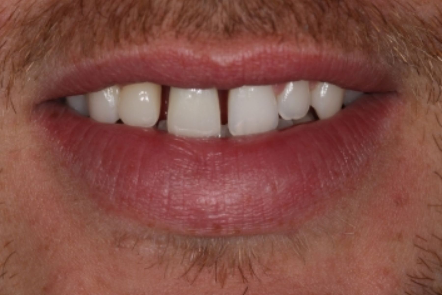 after dental implant