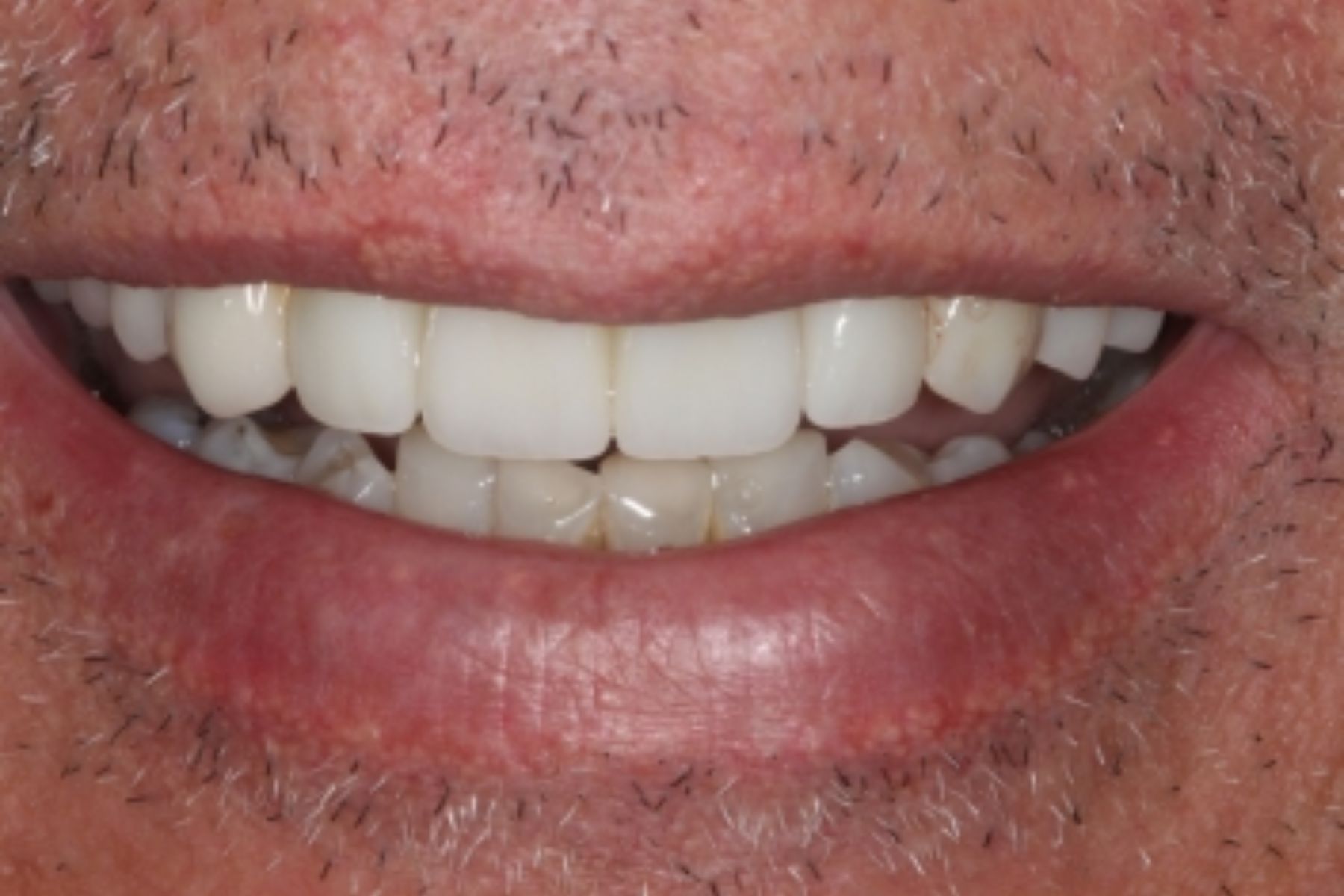 after implant image