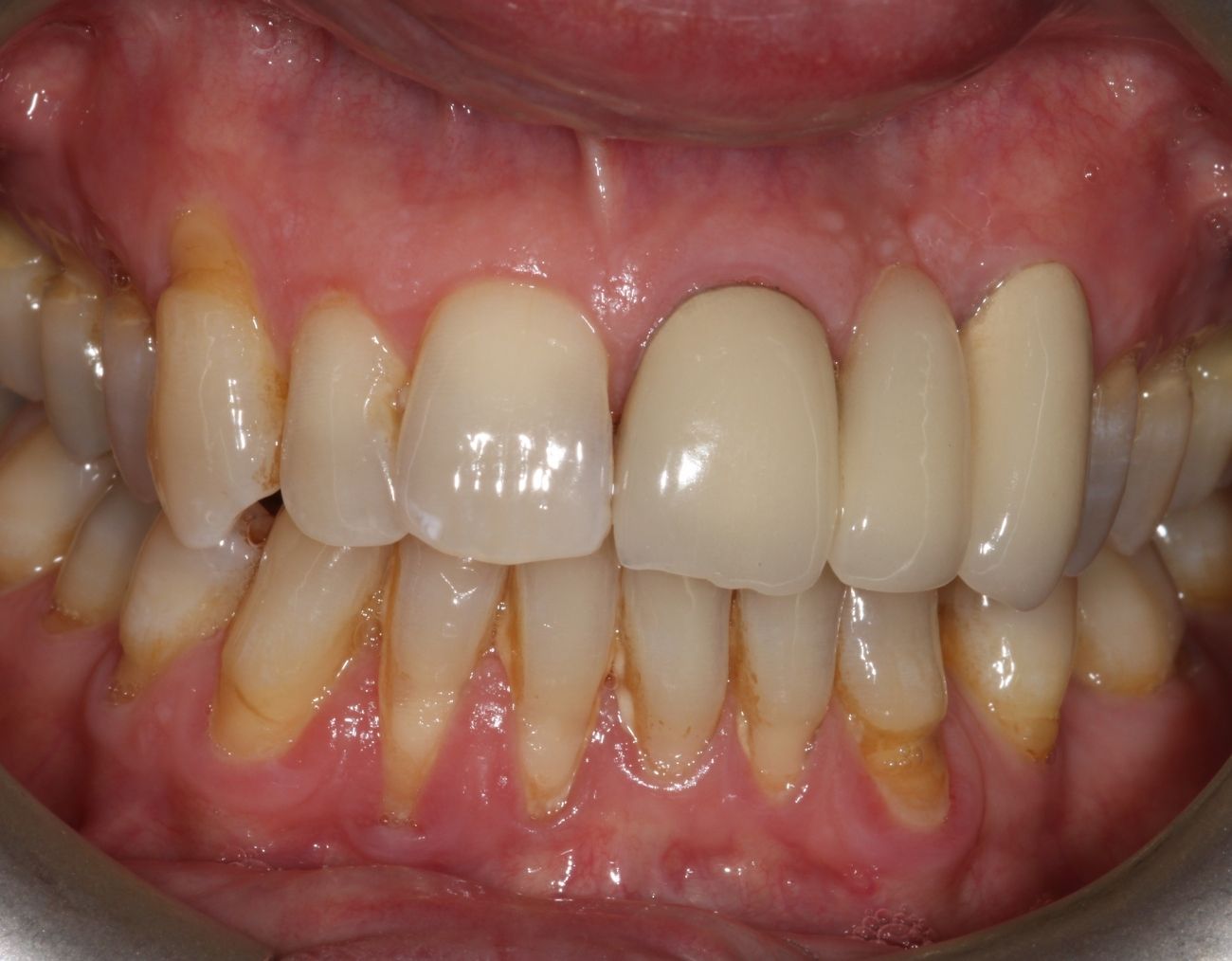 smile makeover before