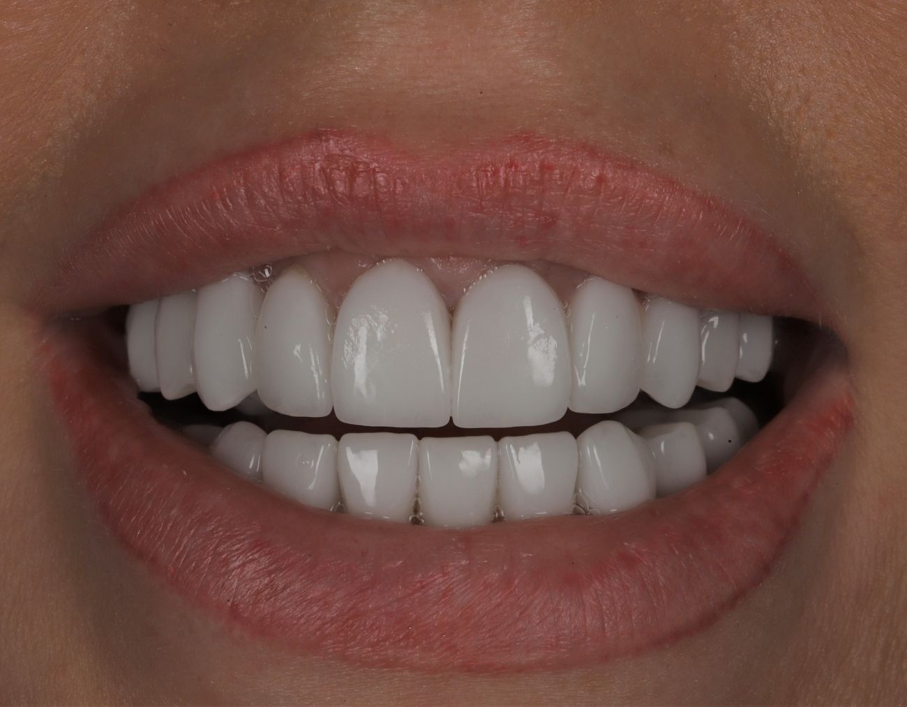 veneer replacement after