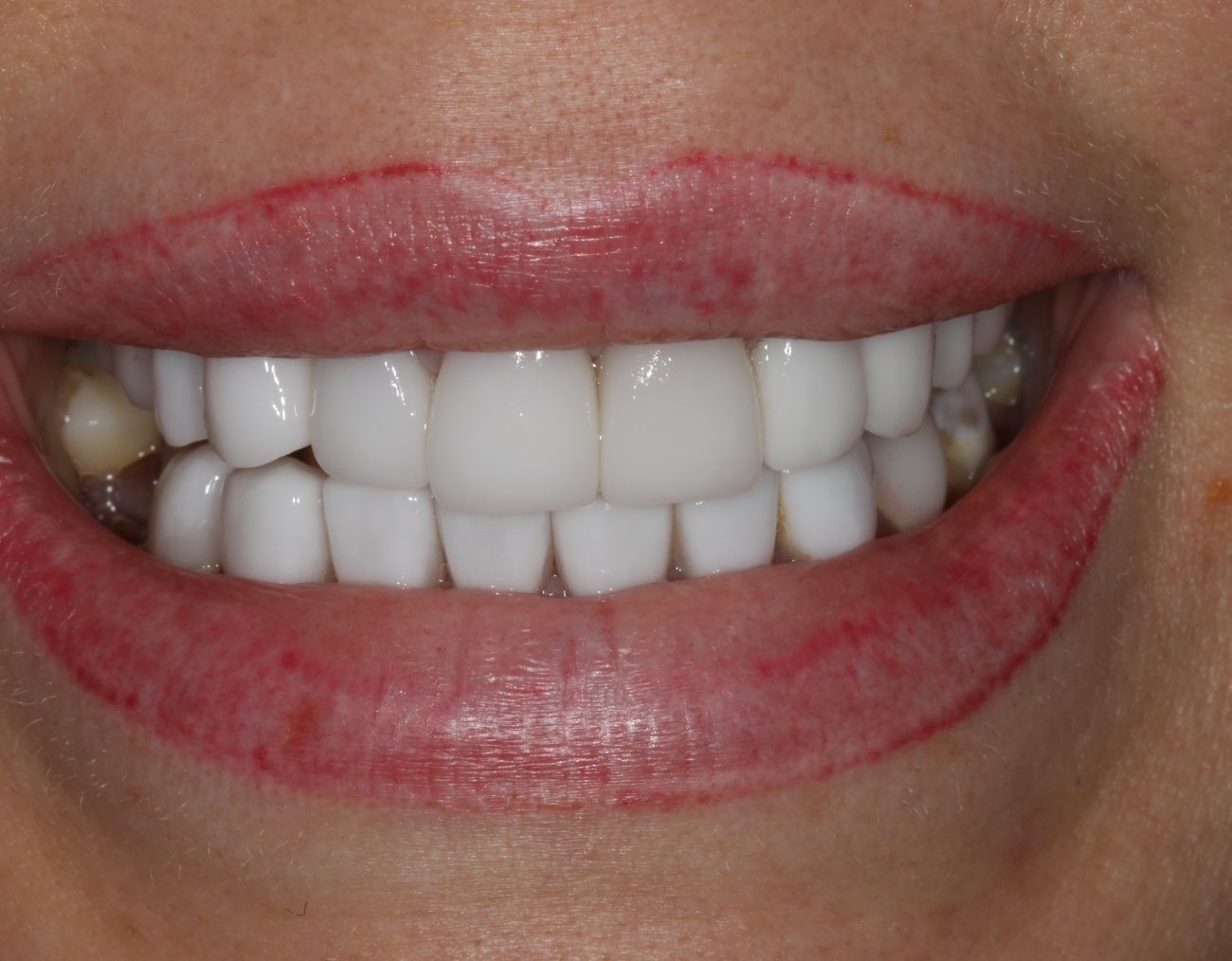 veneer replacement before photo