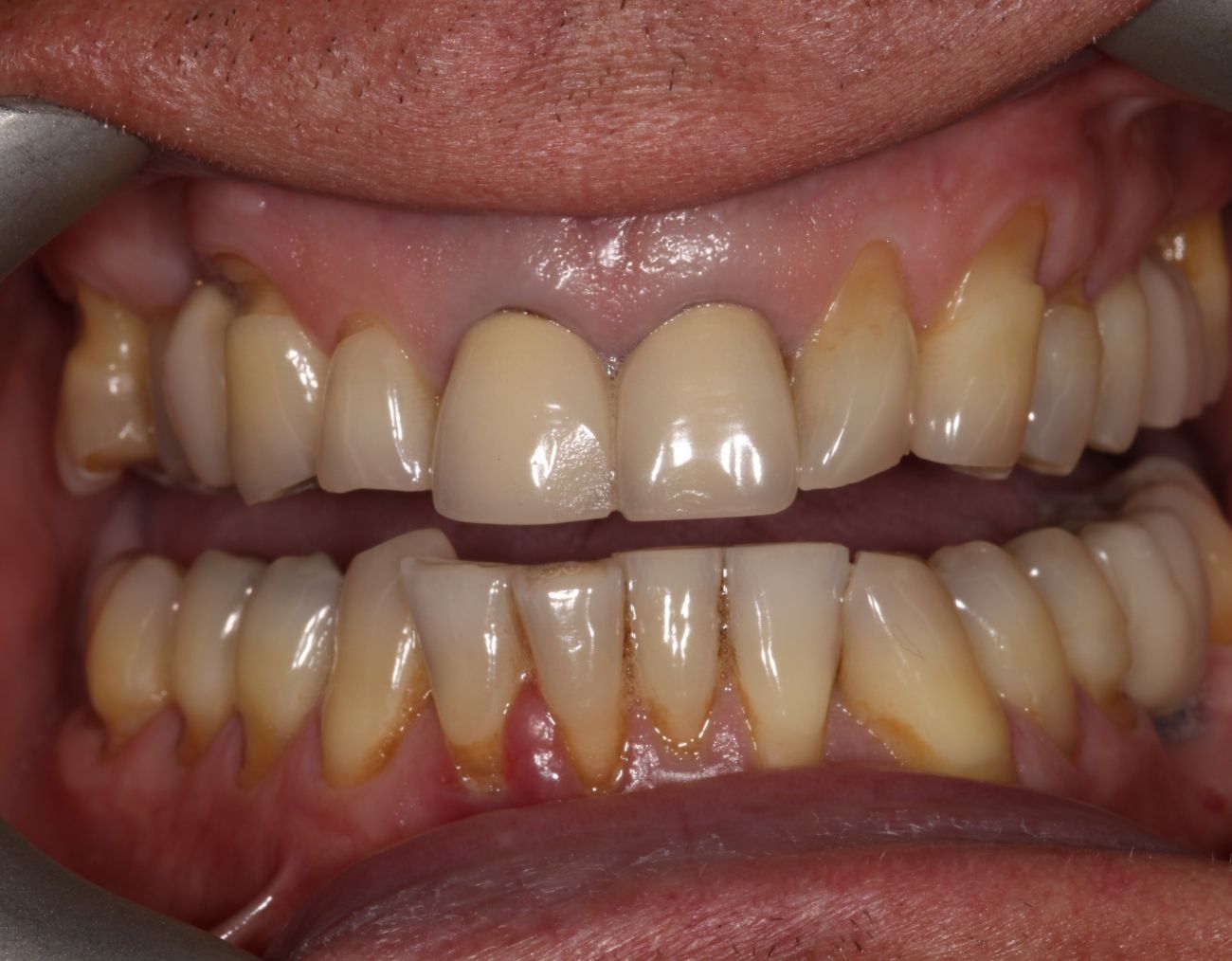 veneers before photo